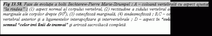 Text Box: Fig 13.58. Faze de evolutie a bolii Bechterew-Pierre Marie-Strumpel : A – coloana vertebrala cu aspect ajustat “la rindea” : (1) aspect normal al corpului vertebral, (2) rectitudine a zidului vertebral anterior cu unghiurile marginale ale corpilor drepte (900), (3) osteofitoza marginala, (4) sindesmofitoza ; B,C – osificarea ligamentului vertebral anterior si a ligamentelor interapofizare si intervertebrale ; D – aspect in “coloana de bambus” cu semnul “celor trei linii de tramvai” si artroza sacroiliaca completa.
