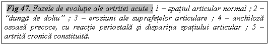 Text Box: Fig 47. Fazele de evolutie ale artritei acute : 1 - spatiul articular normal ; 2 - 