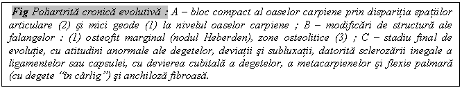 Text Box: Fig Poliartrita cronica evolutiva : A - bloc compact al oaselor carpiene prin disparitia spatiilor articulare (2) si mici geode (1) la nivelul oaselor carpiene ; B - modificari de structura ale falangelor : (1) osteofit marginal (nodul Heberden), zone osteolitice (3) ; C - stadiu final de evolutie, cu atitudini anormale ale degetelor, deviatii si subluxatii, datorita sclerozarii inegale a ligamentelor sau capsulei, cu devierea cubitala a degetelor, a metacarpienelor si flexie palmara (cu degete 