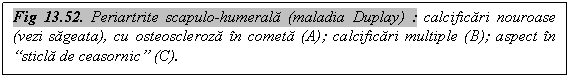 Text Box: Fig 13.52. Periartrite scapulo-humerala (maladia Duplay) : calcificari nouroase (vezi sageata), cu osteoscleroza in cometa (A); calcificari multiple (B); aspect in 