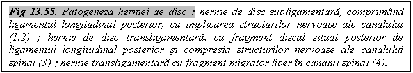 Text Box: Fig 13.55. Patogeneza herniei de disc : hernie de disc subligamentara, comprimand ligamentul longitudinal posterior, cu implicarea structurilor nervoase ale canalului (1.2) ; hernie de disc transligamentara, cu fragment discal situat posterior de ligamentul longitudinal posterior si compresia structurilor nervoase ale canalului spinal (3) ; hernie transligamentara cu fragment migrator liber in canalul spinal (4).