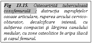 Text Box: Fig 13.15. Osteoartrita tuberculoasa coxofemurala : distructia suprafetelor osoase articulare, ruperea arcului cervico-obturator, decalcificare intensa, cu subtierea compactei si largirea canalului medular, cu zone osteolitice in aripa iliaca si capul femural.