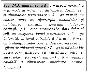 Text Box: Fig. 14.3. Saua turceasca : 1 - aspect normal; 2 - sa moderat marita, cu distrugerea dosului seii si clinoidelor posterioare ; 3 - sa marita, cu contur dens, cu hipertrofia clinoidelor si aplatizarea sinusului sfenoidal (adenom eozinofil) ; 4 - cioc acromegalic, fund dubu al seii, cu subtierea lamei patrulatere ; 5 - sa balonata, cu lama patrulatera distrusa ; 6 - sa cu prelungire anterioara si deformarea acesteia (gliom de chiasma optica) ; 7 - sa plata clinoide posterioare distruse, cu calcificare intra si supraselara (cranio-faringiom) ; 8 - refulare caudala a clinoidelor anterioare (cranio-faringiom).