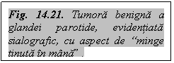 Text Box: Fig. 14.21. Tumora benigna a glandei parotide, evidentiata sialografic, cu aspect de 