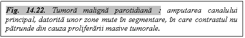 Text Box: Fig. 14.22. Tumora maligna parotidiana : amputarea canalului principal, datorita unor zone mute in segmentare, in care contrastul nu patrunde din cauza proliferarii masive tumorale.

