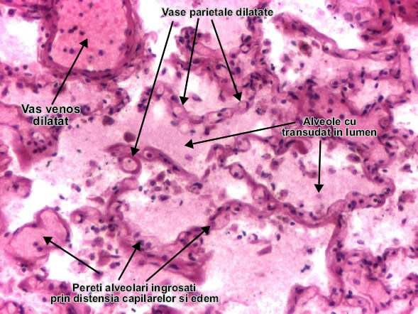 Edemul pulmonar