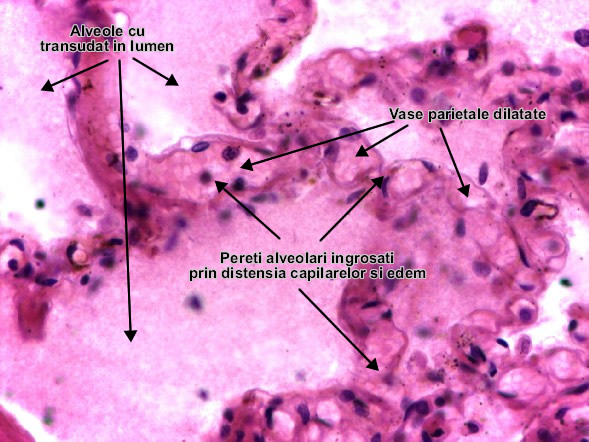 Edemul pulmonar (detaliu)