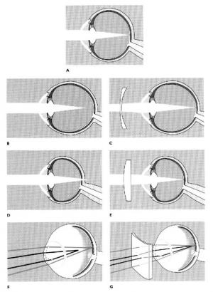 metode de refracție a oftalmologiei