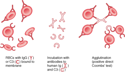 Direct Coombs' Test.