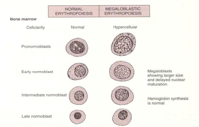 eritropoeza megaloblastica in maduva