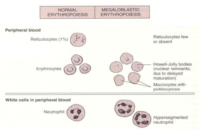 eritropoeza megaloblastica sg periferic